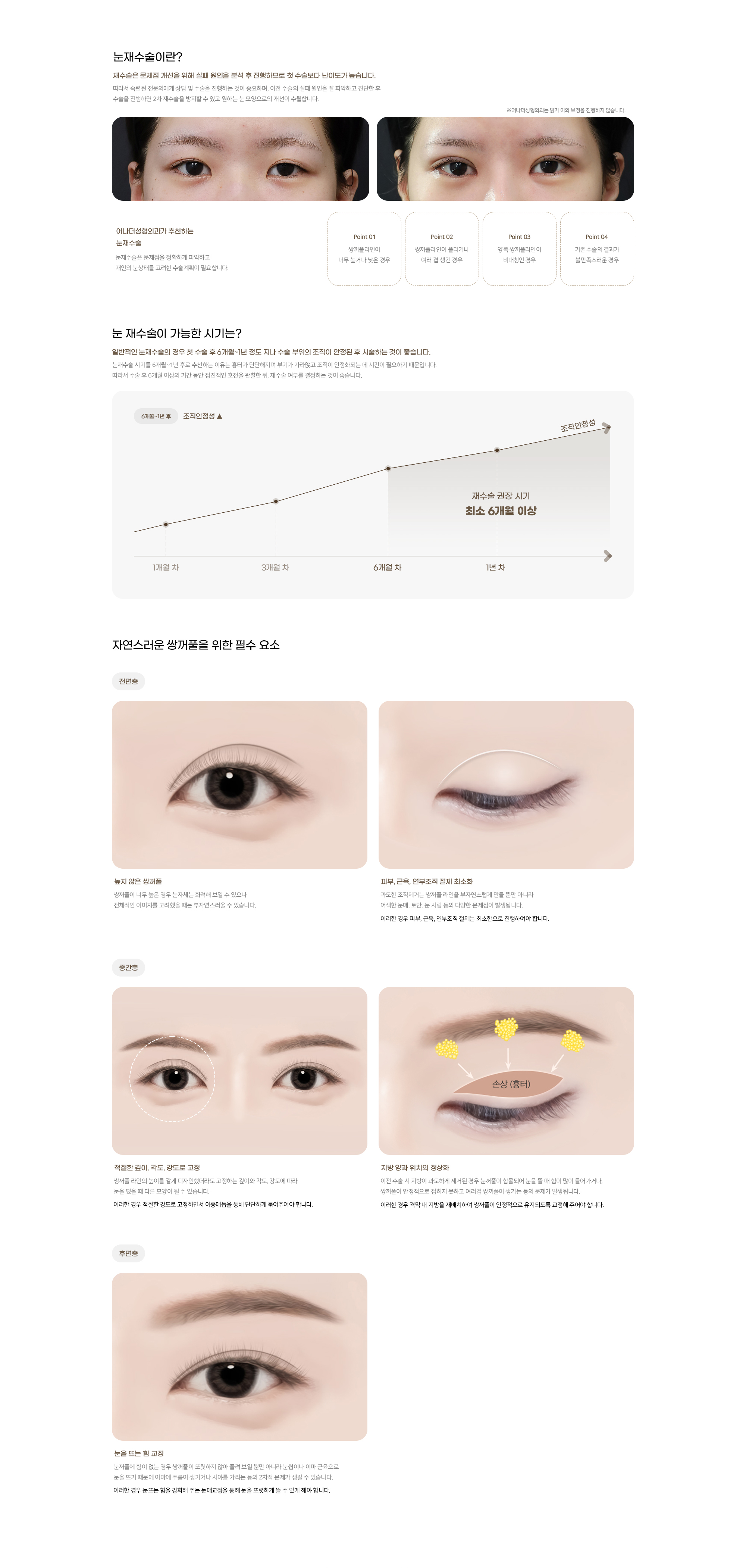 눈재수술